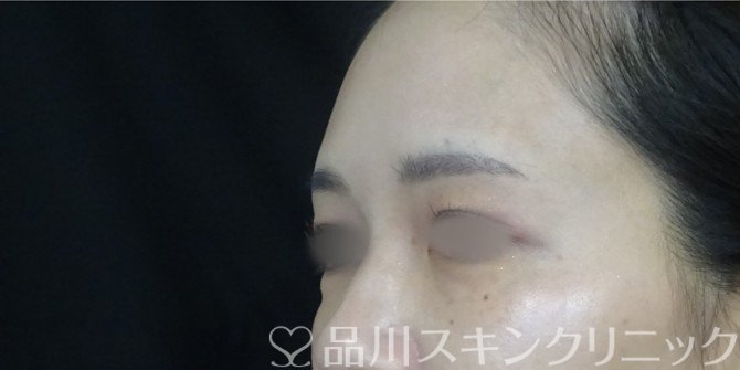 症例NO.71154のBEFORE写真