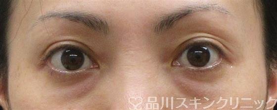 症例NO.60356のBEFORE写真
