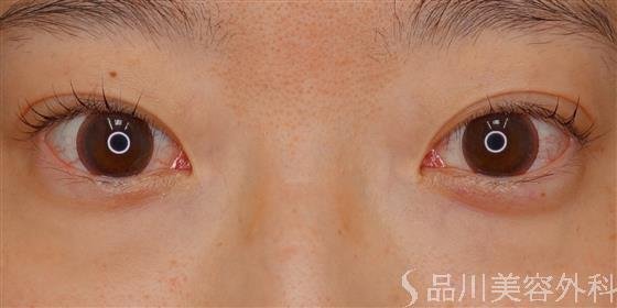 症例NO.61180のAFTER写真