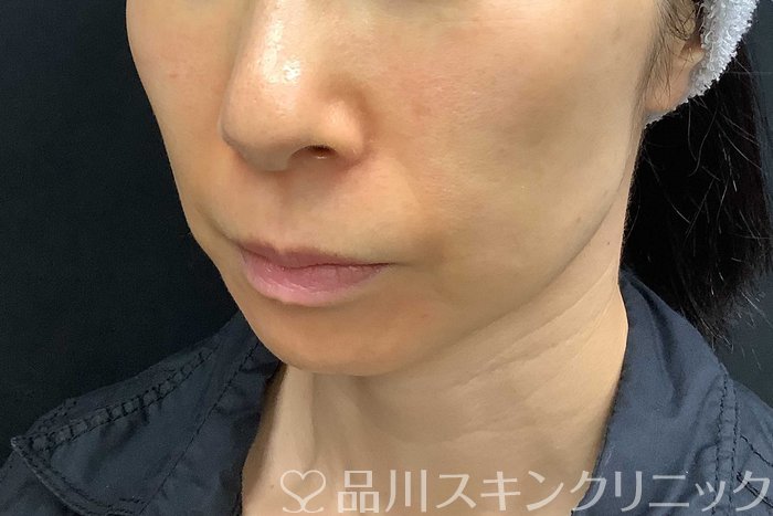 症例NO.69840のBEFORE写真
