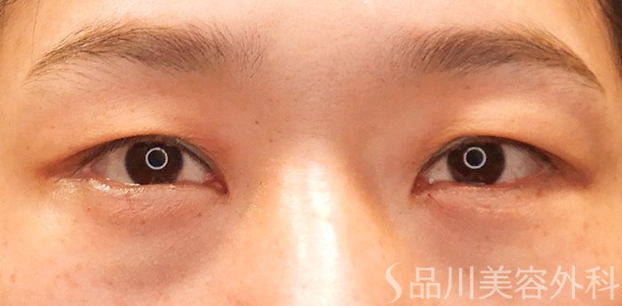 症例NO.69805のAFTER写真