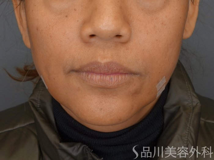 症例NO.72276のAFTER写真