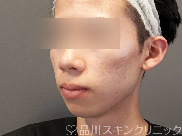 症例NO.68375のBEFORE写真