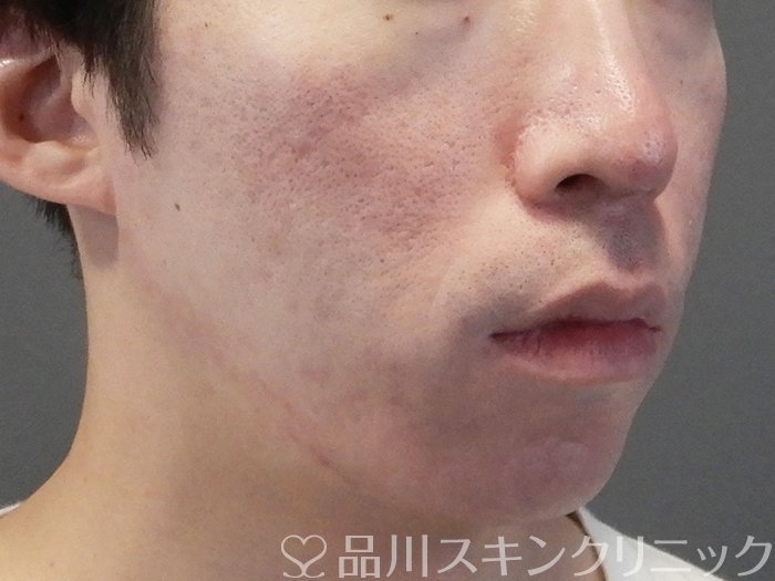 症例NO.69377のAFTER写真