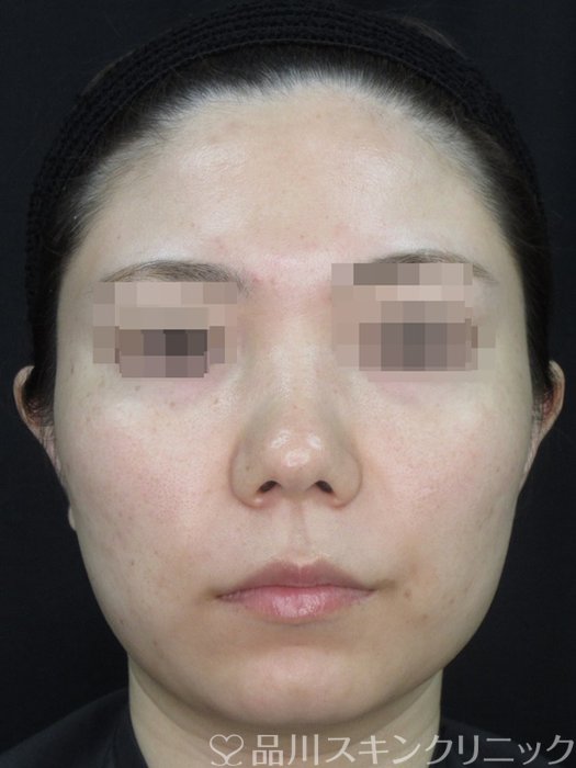 症例NO.73709のAFTER写真