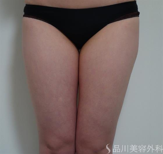 症例NO.36747のBEFORE写真