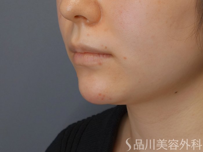 症例NO.72146のAFTER写真
