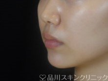 症例NO.74377のAFTER写真