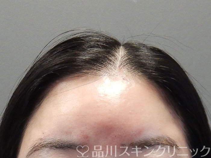 症例NO.72790のAFTER写真