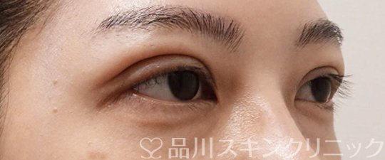 症例NO.65256のAFTER写真