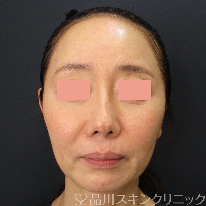 症例NO.72233のBEFORE写真