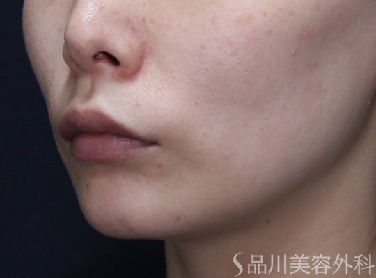 症例NO.74228のBEFORE写真