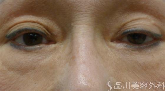症例NO.39969のBEFORE写真