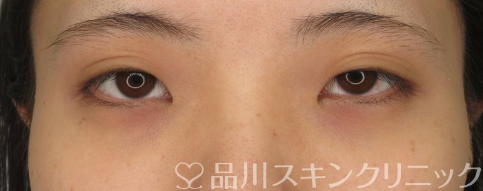 症例NO.74022のBEFORE写真