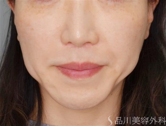 症例NO.54521のBEFORE写真