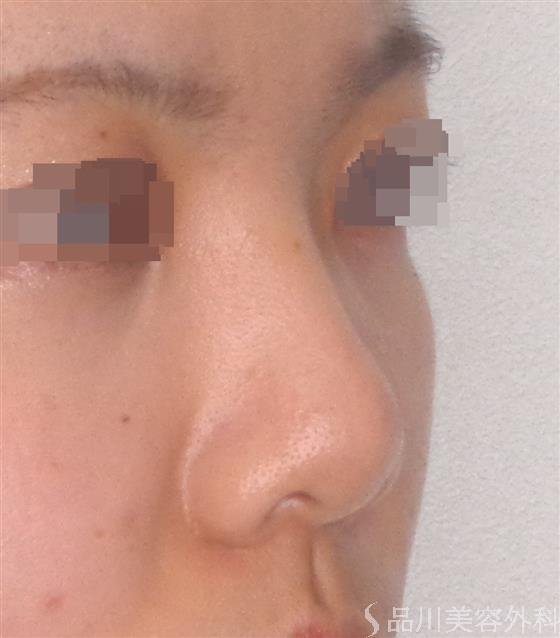 症例NO.49481のBEFORE写真
