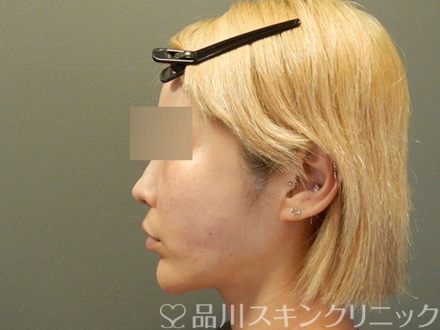 症例NO.65754のAFTER写真