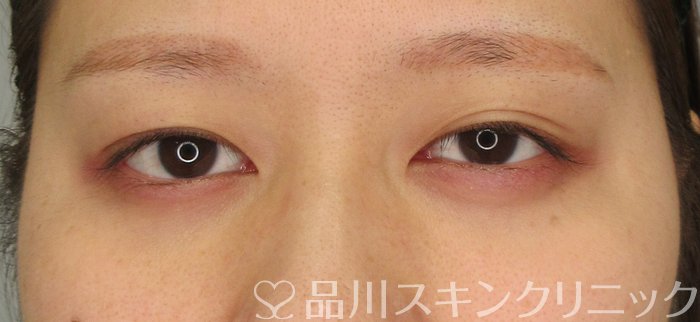 症例NO.70933のBEFORE写真