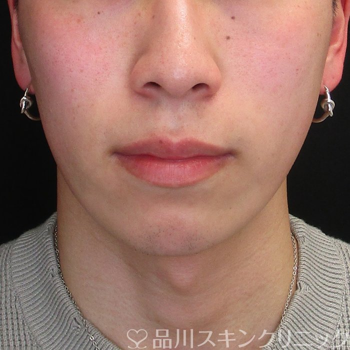 症例NO.73728のBEFORE写真