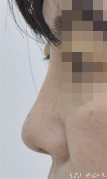 症例NO.51712のAFTER写真