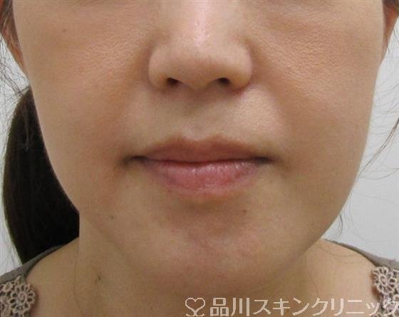 症例NO.37351のBEFORE写真