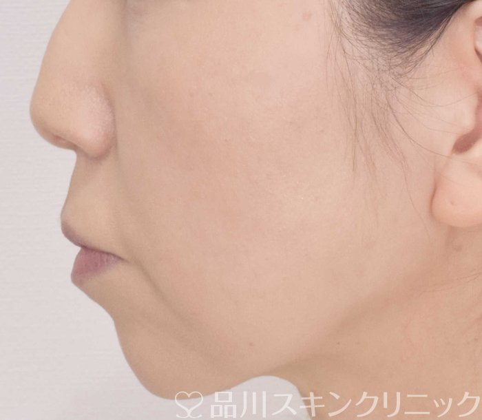 症例NO.72316のBEFORE写真