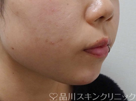 症例NO.64622のAFTER写真