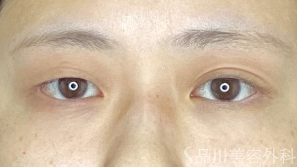 症例NO.67642のBEFORE写真