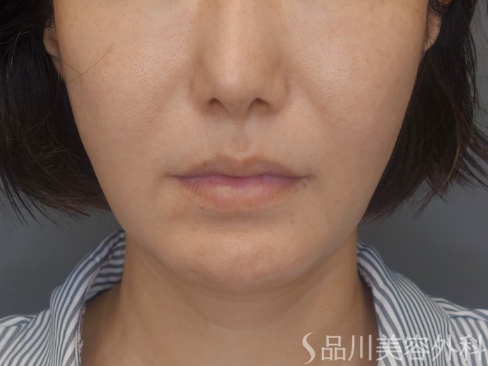 症例NO.71990のBEFORE写真