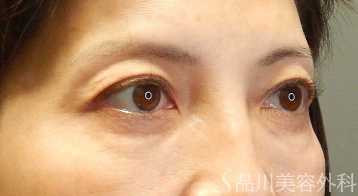 症例NO.69496のBEFORE写真