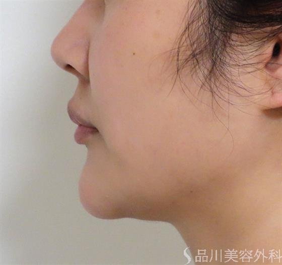 症例NO.38011のAFTER写真