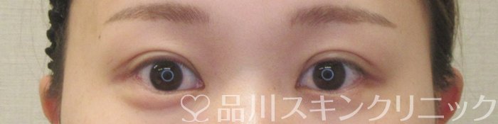 症例NO.73938のAFTER写真