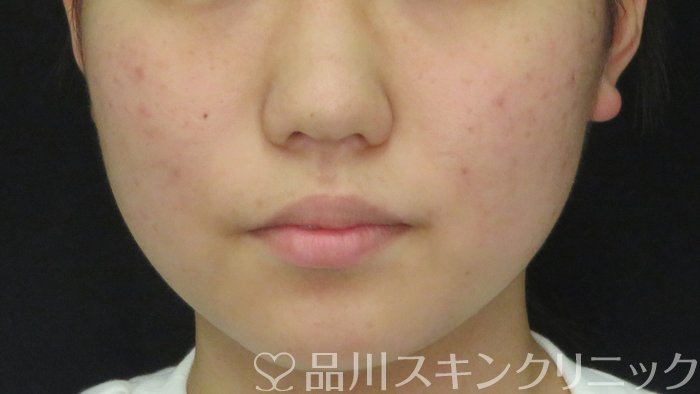 症例NO.71469のAFTER写真