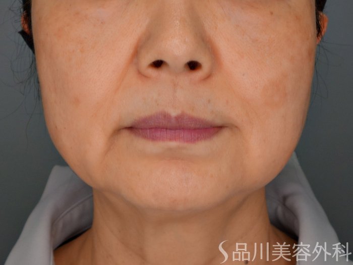 症例NO.73188のBEFORE写真