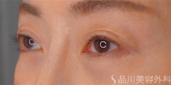 症例NO.55177のAFTER写真