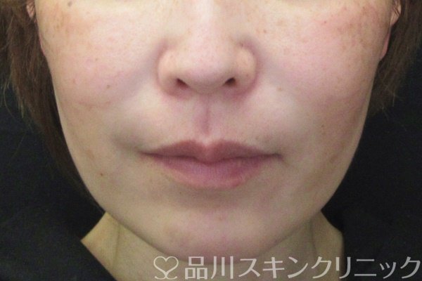 症例NO.65696のBEFORE写真