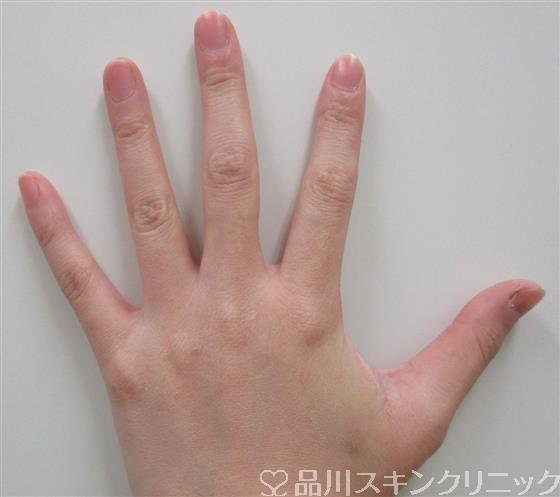 症例NO.33966のAFTER写真
