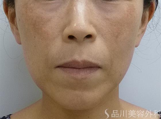 症例NO.22528のBEFORE写真
