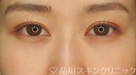 症例NO.71009のAFTER写真