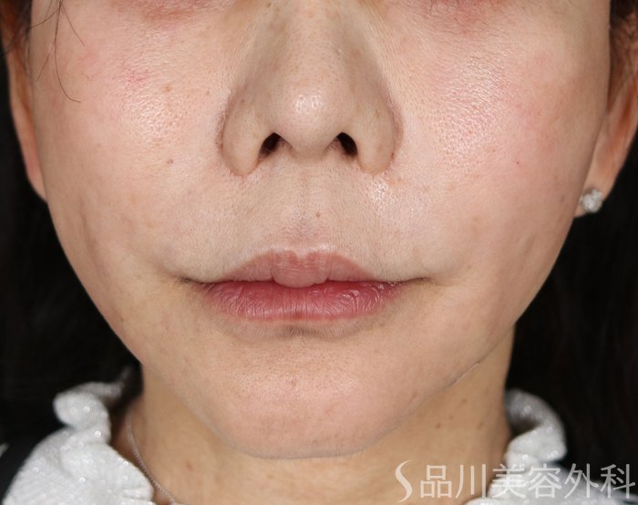 症例NO.72058のAFTER写真