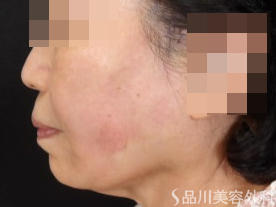 症例NO.71030のAFTER写真