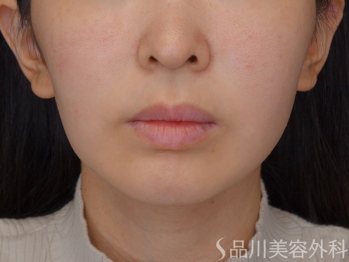 症例NO.72688のBEFORE写真