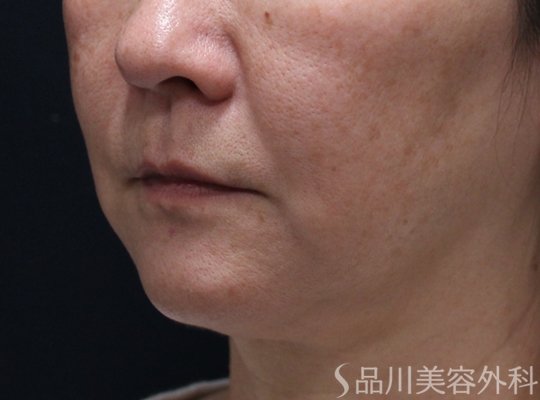 症例NO.73097のBEFORE写真