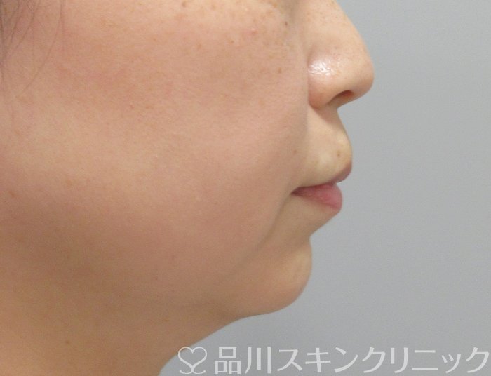 症例NO.70413のAFTER写真