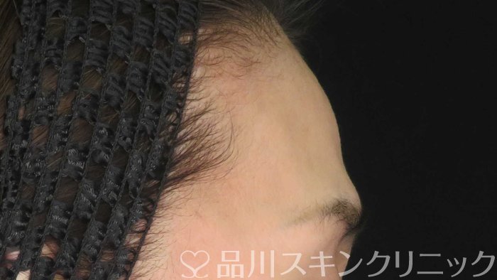 症例NO.71611のBEFORE写真