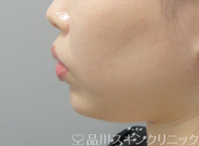 症例NO.70805のAFTER写真