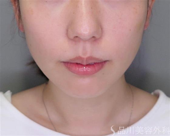 症例NO.46798のBEFORE写真