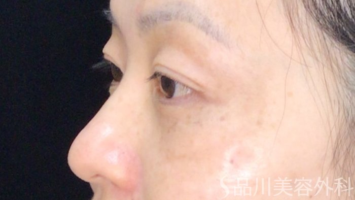 症例NO.72199のAFTER写真