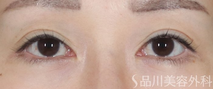 症例NO.73992のBEFORE写真