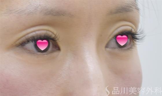 症例NO.46869のBEFORE写真